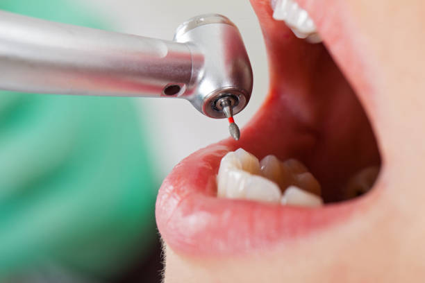 Best Emergency Tooth Extraction in Wildwood, MO